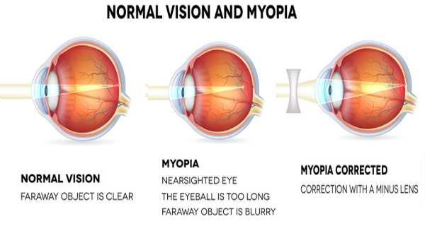 testmozgás emberekkel myopia myopia